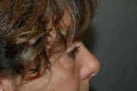 Eyelid Lift