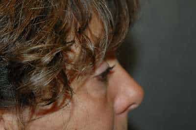 Eyelid Lift