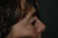 Eyelid Lift