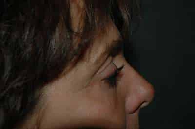 Eyelid Lift