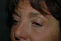 Eyelid Lift
