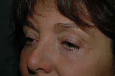 Eyelid Lift