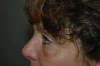 Eyelid Lift