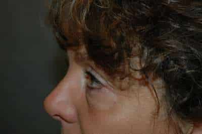 Eyelid Lift