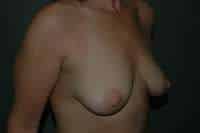 Breast Augmentation
