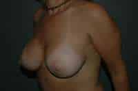 Breast Augmentation