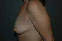 Breast Augmentation