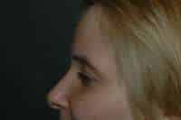 Rhinoplasty