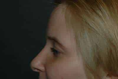 Rhinoplasty