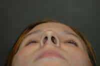 Rhinoplasty