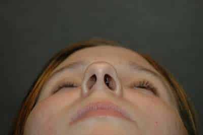 Rhinoplasty