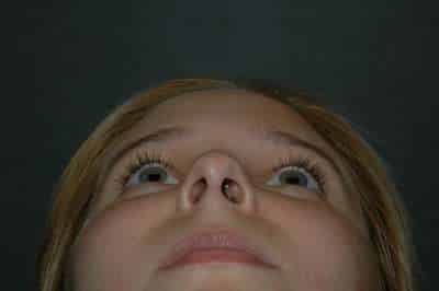 Rhinoplasty