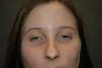 Rhinoplasty