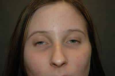 Rhinoplasty