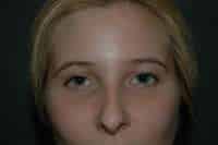 Rhinoplasty