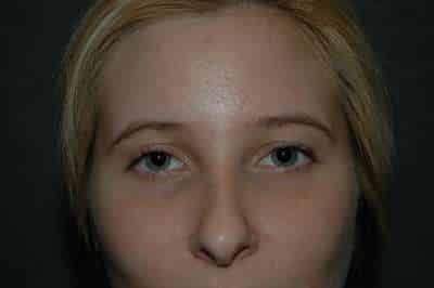 Rhinoplasty