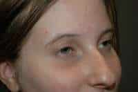 Rhinoplasty
