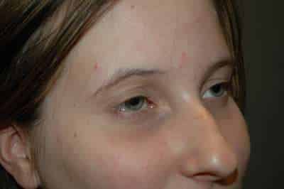 Rhinoplasty