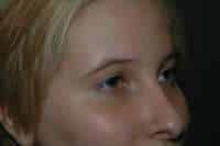 Rhinoplasty