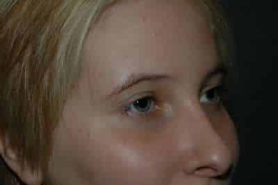 Rhinoplasty