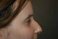 Rhinoplasty
