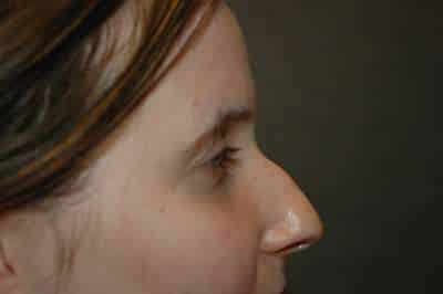 Rhinoplasty