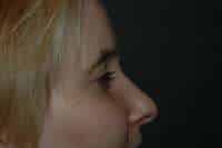 Rhinoplasty