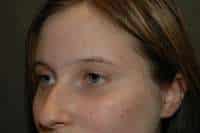 Rhinoplasty