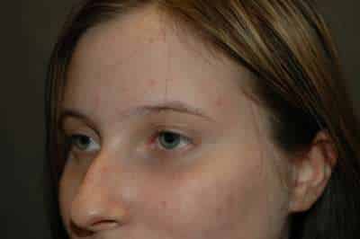 Rhinoplasty