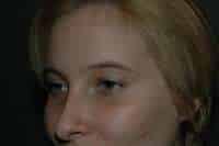 Rhinoplasty
