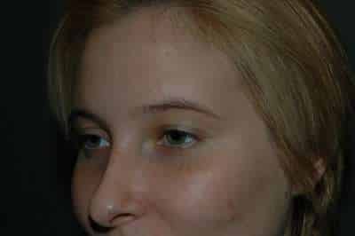 Rhinoplasty