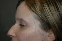 Rhinoplasty