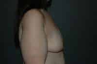 Breast Lift