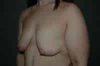 Breast Lift