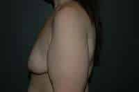 Breast Lift
