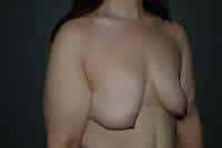 Breast Lift