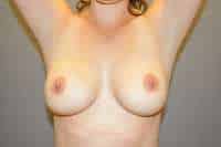 Breast Augmentation