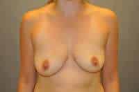 Breast Augmentation