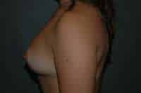 Breast Augmentation
