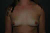 Breast Augmentation