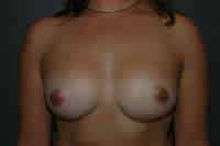 Breast Augmentation