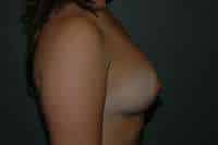 Breast Augmentation