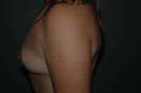 Breast Augmentation