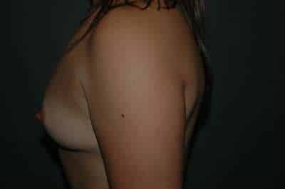 Breast Augmentation