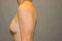 Breast Augmentation