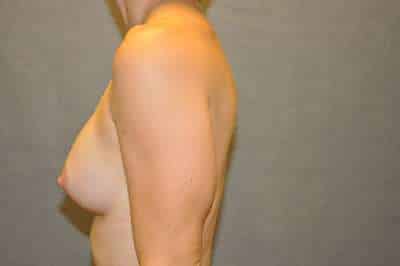 Breast Augmentation