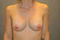 Breast Augmentation