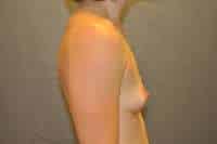 Breast Augmentation