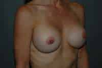 Breast Implant Exchange