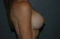 Breast Implant Exchange